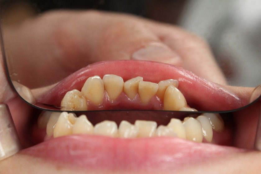 Govers M biologisch tandarts angst tandarts