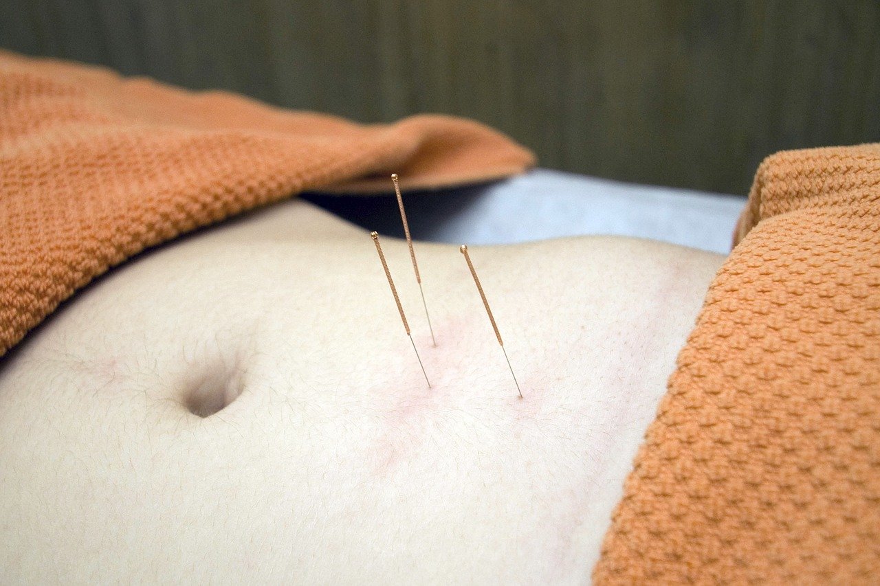 Fysiotherapie Marc Geers Apeldoorn dry needling