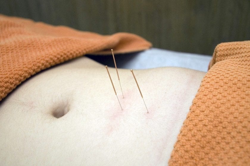Fysiotherapie Zwartsluis dry needling
