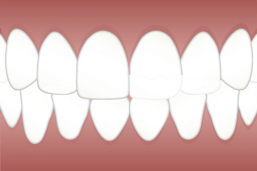 Tandarstenpost Hoensbroek wanneer spoed tandarts