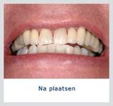 Kliniek voor Cosmetische Tandheelkunde Amsterdam Zuid tandarts lachgas