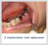 Kliniek voor Cosmetische Tandheelkunde Amsterdam Zuid tandarts onder narcose