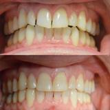 Tandheelkunde Goudsesingel tandarts onder narcose