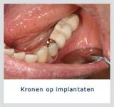 Kliniek voor Cosmetische Tandheelkunde Amsterdam Zuid wanneer spoed tandarts